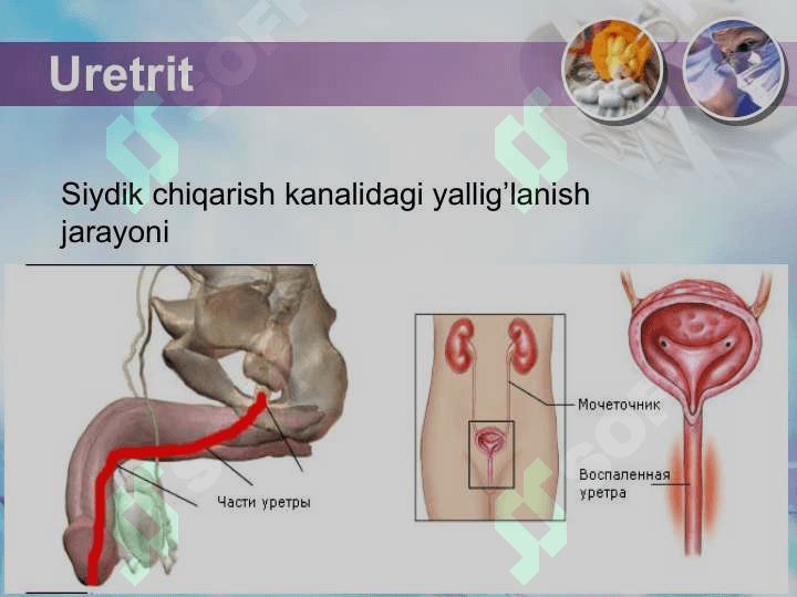 Uretrit , orxit , orxoepididemit 3