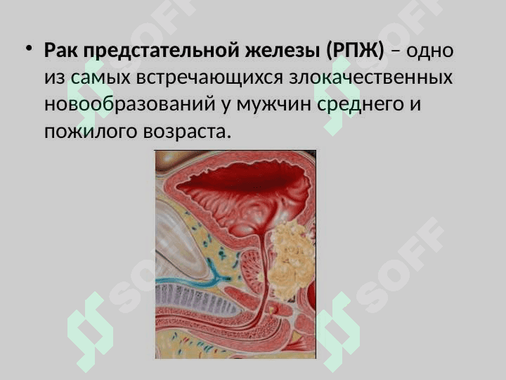 Рак предстательной железы 2