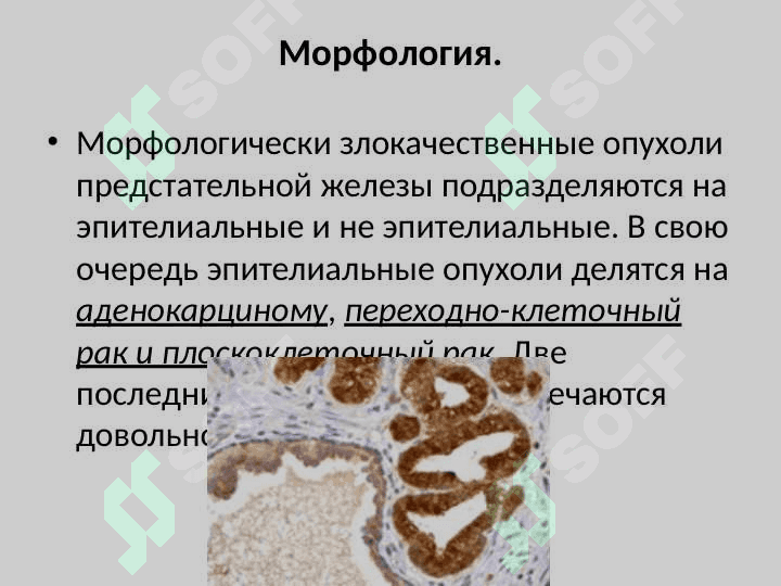 Рак предстательной железы 5