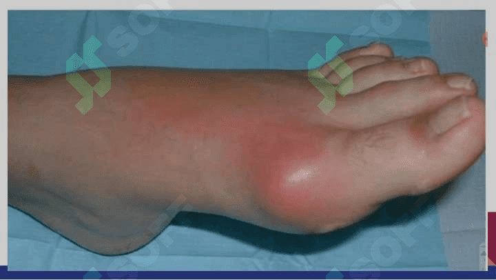 Podagra , etiopatogenezi , klinikasi , davolash usullari 6