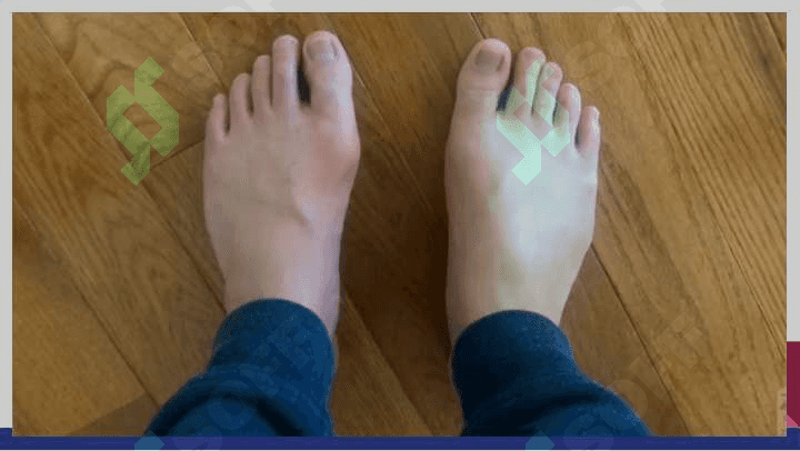Podagra , etiopatogenezi , klinikasi , davolash usullari 8
