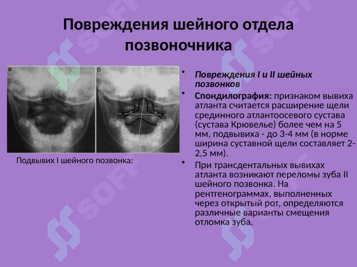 Лучевая диагностика заболеваний и повреждений позвоночника 3