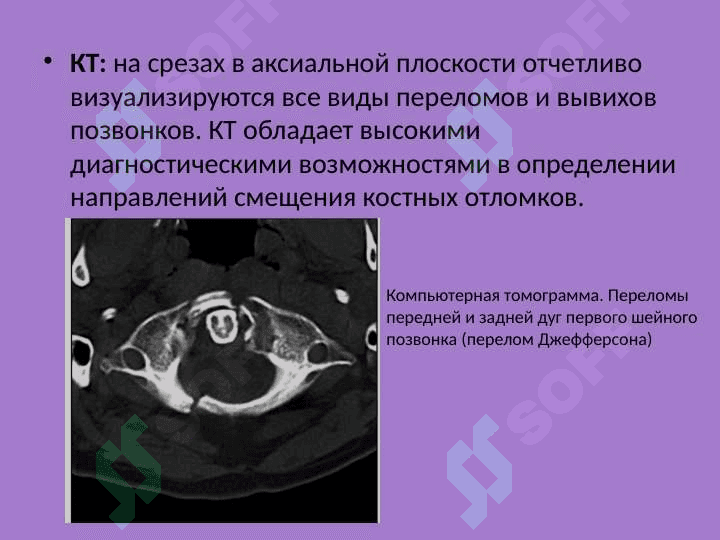 Лучевая диагностика заболеваний и повреждений позвоночника 4