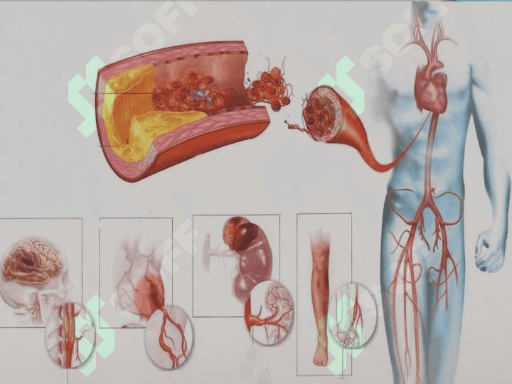 Lerish sindromi . Etiologiyasi , patogenezi, klinikasi , diagnostikasi va davolash 4