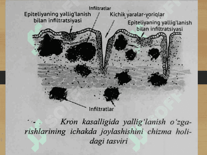 Kron kasalligi , etiologiyasi , epidemiologiyasi , klinikasi , kechishi va davolash usullari 6