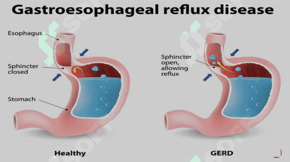 Gastroezofageal refluks (GERK) etiologiyasi ,patogenezi ,klinikasi va davolash usullari 3