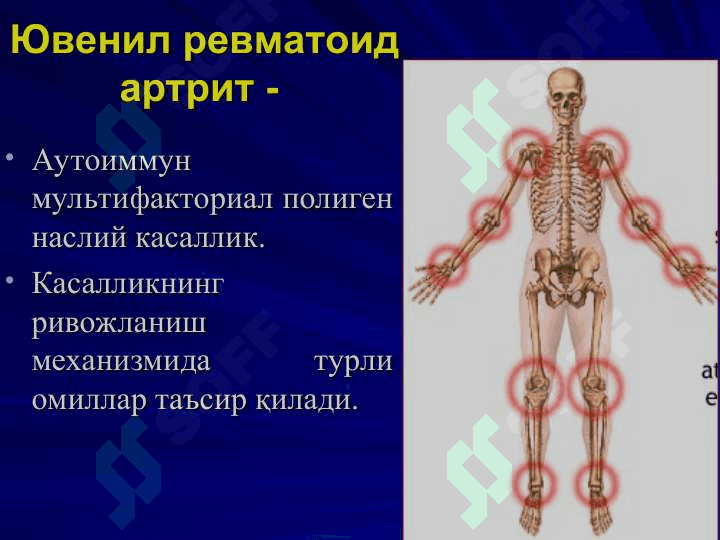 ЮВЕНИЛ РЕВМАТОИД АРТРИТ 4