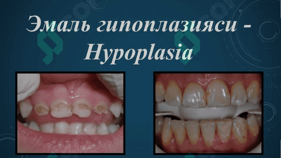 Emal gipoplaziya va flyuroz 4