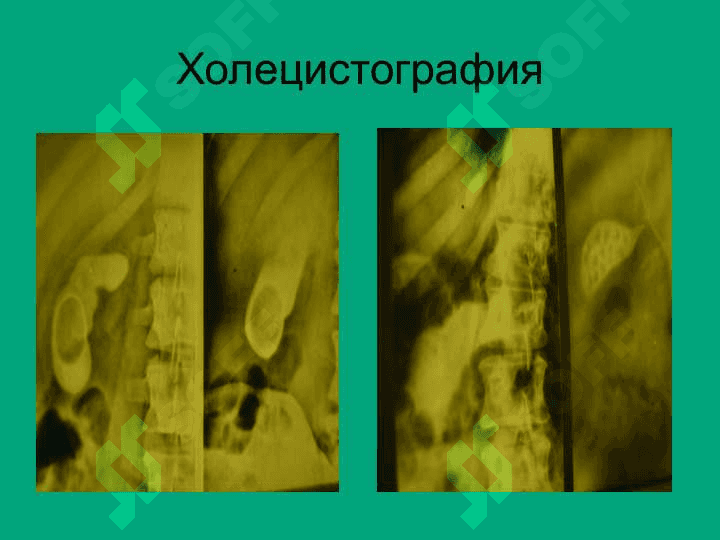АБОЛЕВАНИЯ ЖЕЛЧНОГО ПУЗЫРЯ И ЖЕЛЧЕВЫВОДЯЩИХ ПУТЕЙ 7