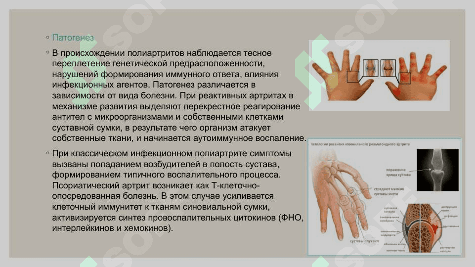 Острый идиопатический полиартрит 4