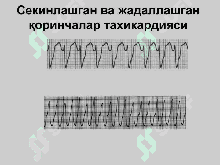 Кардиологик шошилинч ёрдам. Аритмиялар, таърифи, клиник белгилари. Юрак етишмовчилиги. Кардиоген шок, Юрак тўхташи ва тўсатдан ўлим. Юракнинг электромеханик диссоциацияси. Периферик қон томир шошилинч ҳолатлари 3