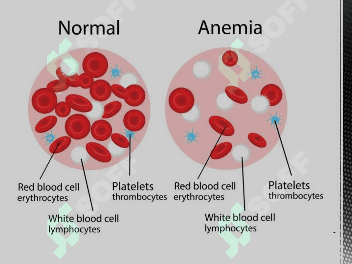 Aplastik Anemiya: Alomatlar. Aplastik Anemiya Diagnostikasi Va Davolash 8