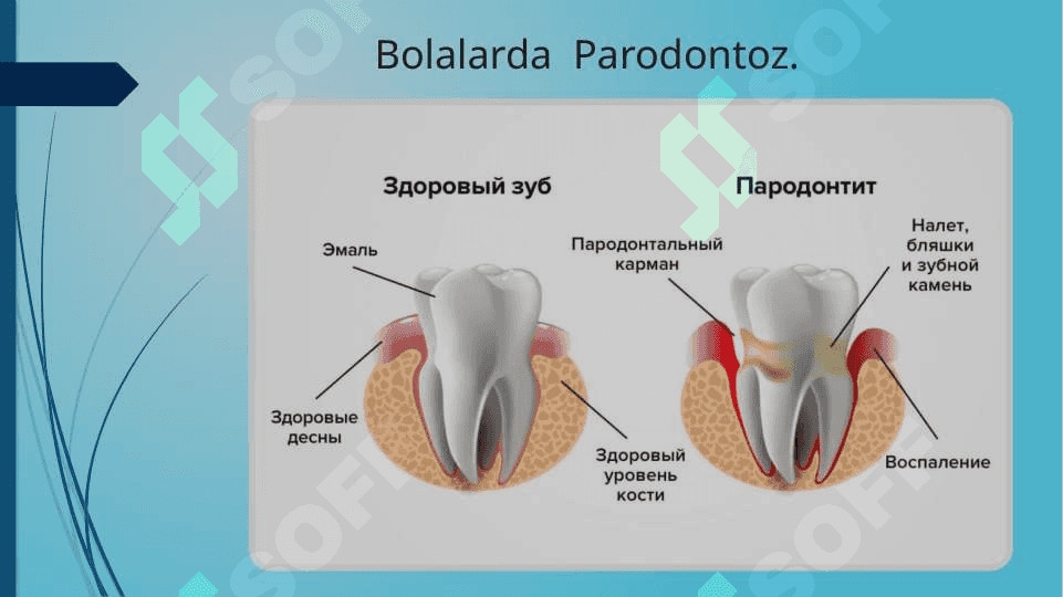 Bolalarda parodontoz 4