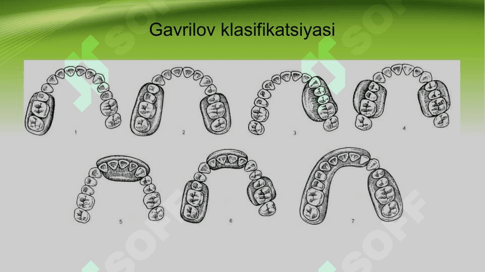 Tish qatorlari qisman nuqsonlarining Gavrilov, Engel va Oksman bo’yicha tasniflari 6