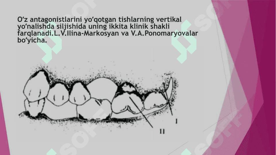 Tish qatori deformatsiyalarini            Gavrilov va Ponomaryova boʻyicha tasniflari 7