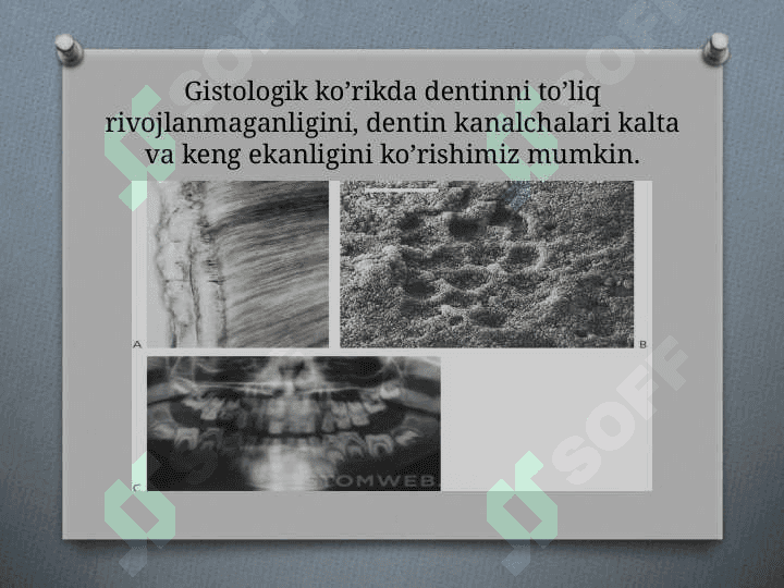 Tish qattiq to’qimasining irsiy kasalliklari 5