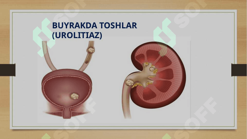 Buyraklarda urat toshlarining hosil bo’lishi va ularning davolash yo’llari 4