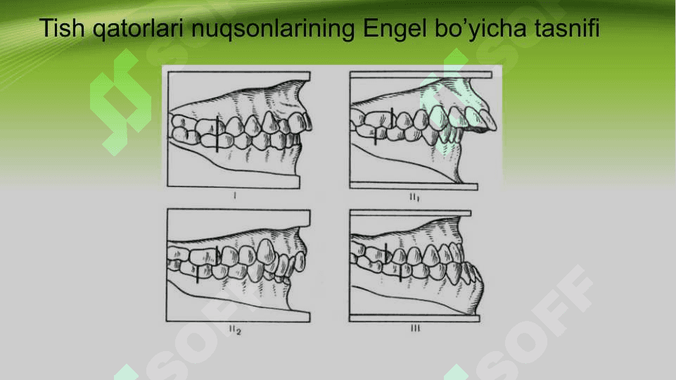 Tish qatorlari qisman nuqsonlarining Gavrilov, Engel va Oksman bo’yicha tasniflari 8