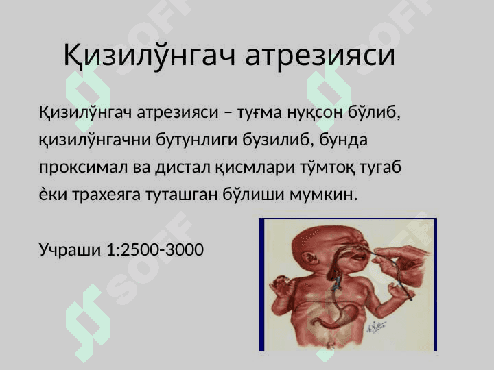 Bolalarda qizilo'ngach tug'ma nuqsonlari . Qizilo'ngachning tug'ma nuqsonlari . Болаларда кизилунгачнинг тугма нуксонлари. Диагностика ва дифференциал диагностикаси  Врач педиатр тактикаси. 2