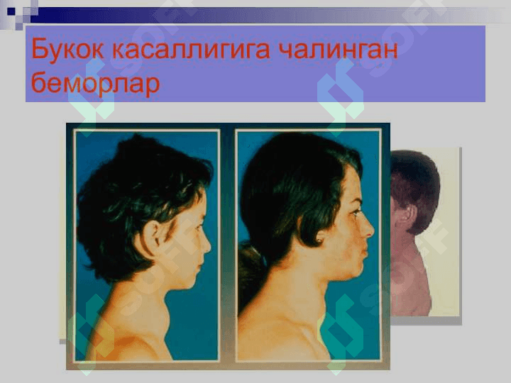 Yod yetishmovchiligi kasalligi 4