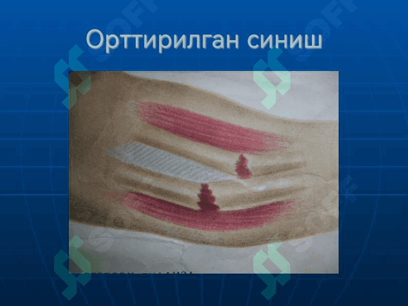 Суякларнинг синиши ва чикиши 5