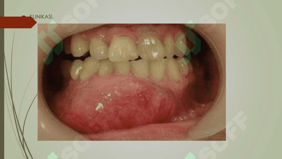 BOLALARDA ODONTOGEN O'SMALAR 3