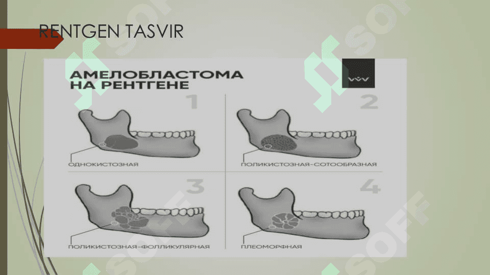 BOLALARDA ODONTOGEN O'SMALAR 5