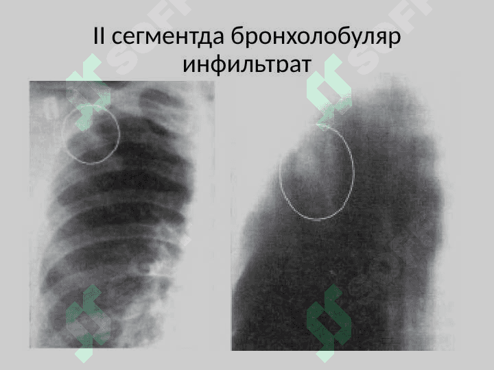 Ўнг ўпкани бронхолобуляр инфильтрати 3
