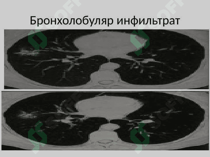 Ўнг ўпкани бронхолобуляр инфильтрати 4