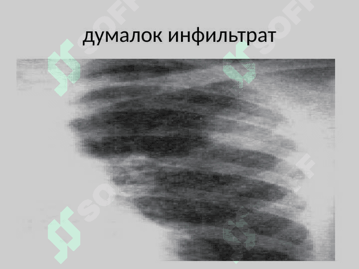 Ўнг ўпкани бронхолобуляр инфильтрати 7