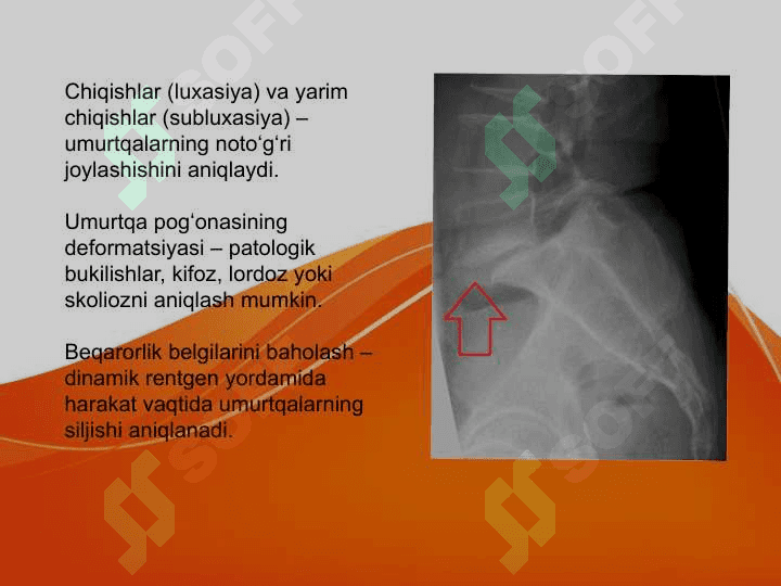 Umurtqa pogʻonasi travmasi 2