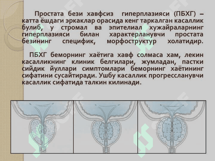 Slayd
Prostata bezi xavsiz giperplaziyasi 2