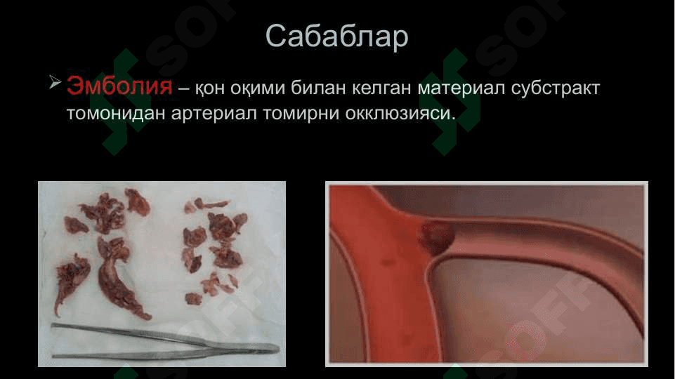 Уткир артериал тутилиш 2