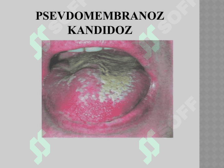 OITSda parodontdagi o’zgarishlar. Klinikasi, qiyosiy tashxis, davolash, profilaktika. 6