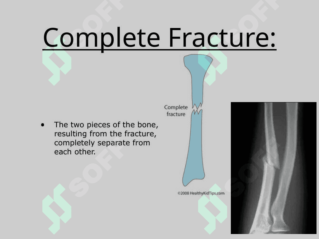 Fractures 6