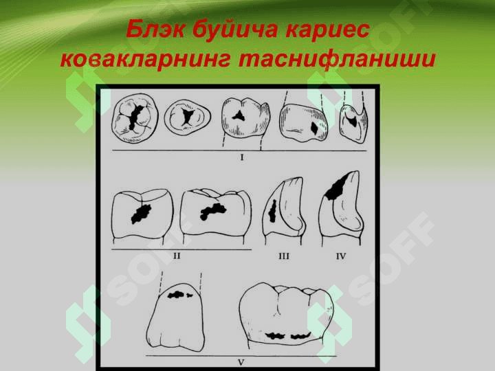 2 sinf karioz bo'shliqlarini charxlash va plombalash . II синф кариоз бушликларини чархлаш ва пломбалаш 3