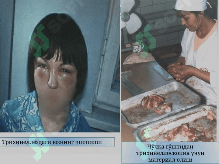 Юмалоқ чувалчанглар типи. Трихинелла. Ришта. Вухарерия. Тиббиётдаги ахамияти. Овогельминтоскопия усуллари. 6