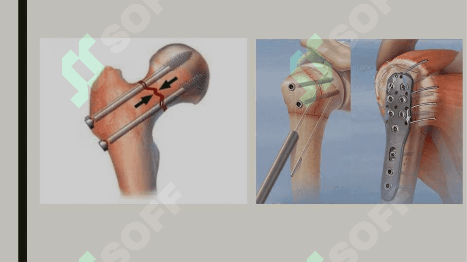SUYAKLARDA JARROHLIK AMALIYOTI Osteosintez 7