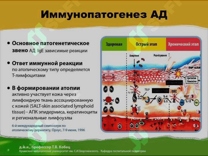 Атопический дерматит 5