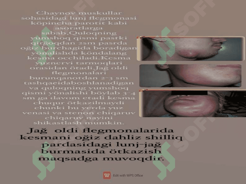 Yuz sohasi jarahotlariga ishlov berish. 4