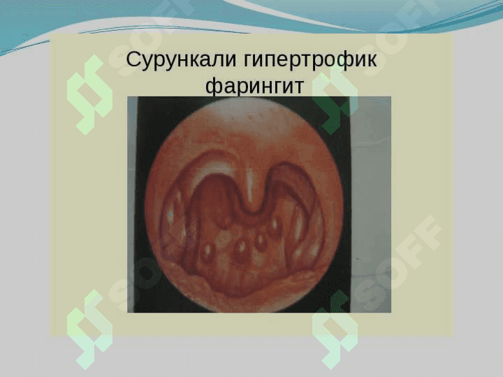 Surunkali faringitetiologiya, klinika, differensial tashhislash,davolash 7