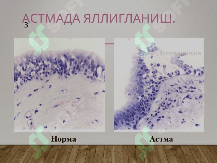 БРОНХИАЛ АСТМА 3