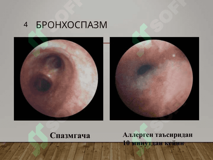 БРОНХИАЛ АСТМА 4