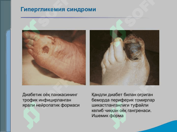 Эндокрин тизими касалликлари бўлган беморларни текшириш. Қандли диабет, гипо ва гипертиреознинг асосий клиник симптомлари 8