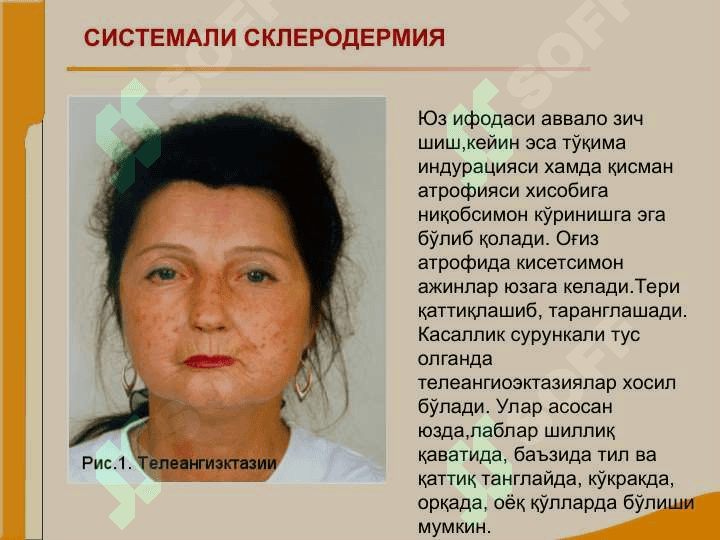 Бўғим ва бириктирувчи тўқима касалликлари билан оғриган беморларни текшириш. СКВ, ССД, РА, ДОА касалликларини асосий клиник  симптомлари 5