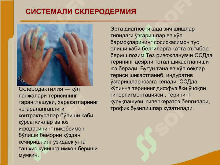 Бўғим ва бириктирувчи тўқима касалликлари билан оғриган беморларни текшириш. СКВ, ССД, РА, ДОА касалликларини асосий клиник  симптомлари 6