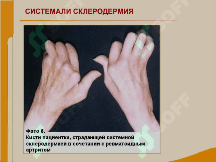 Бўғим ва бириктирувчи тўқима касалликлари билан оғриган беморларни текшириш. СКВ, ССД, РА, ДОА касалликларини асосий клиник  симптомлари 8