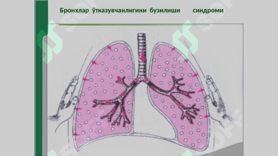 НАФАС  ОРГАНЛАРИ  КАСАЛЛИКЛАРИДА  АСОСИЙКЛИНИК  СИНДРОМЛАР.  БРОНХЛАР  ЎТКАЗУВЧАНЛИГИНИБУЗИЛИШИ, ЎПКА  ТЎҚИМАСИДА  ҲАВОНИ  ОРТИБ  КЕТИШИ  СИНДРОМИ. УПКА ТУКИМАСИНИНГ ЗИЧЛАШИШ СИНДРОМИ, ПЛЕВРА БУШЛИГИГА ХАВО ВА СУЮКЛИК ТУПЛАНИШ СИНДРОМИ, УПКАДА БУШЛИК ХОСИЛ БУЛИШ СИНДРОМИ. 4