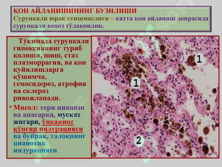 “Қон айланишининг бузилиши. Артериал ва веноз тўлақонлик. Қон кетиши”” QO  AYLANISHINING BUZILISHI 7