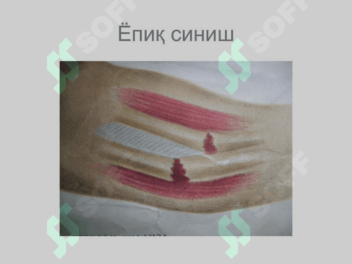 Suyaklarning sinishi va chiqishi diagnostikasi 8